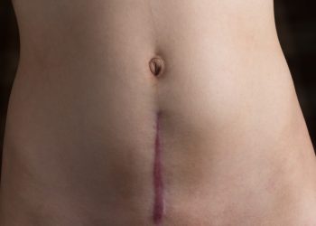 raised and discolored c-section scar