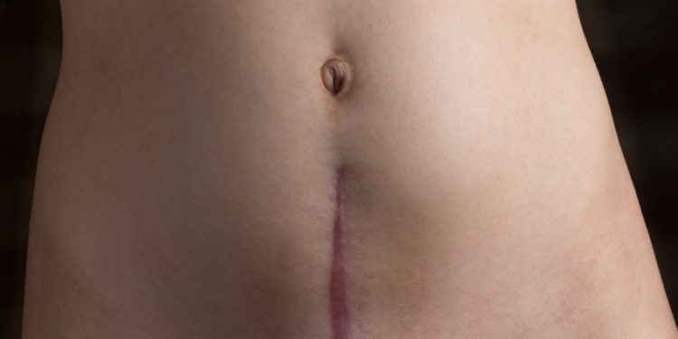 raised and discolored c-section scar