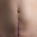 raised and discolored c-section scar