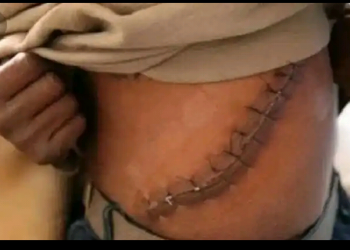 Heartbreaking: Student who sold his kidney for N15,000,000 died two weeks After