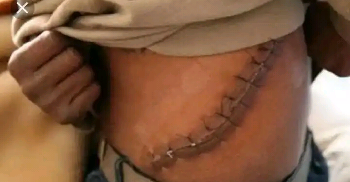 Heartbreaking: Student who sold his kidney for N15,000,000 died two weeks After